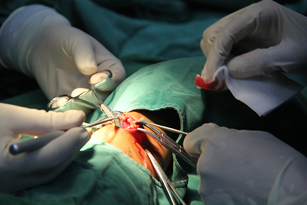 髓周动静脉瘘手术图片